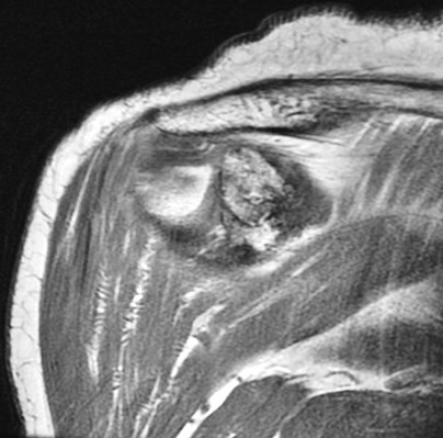 Figure 6 for case Greater tuberosity avulsion fracture